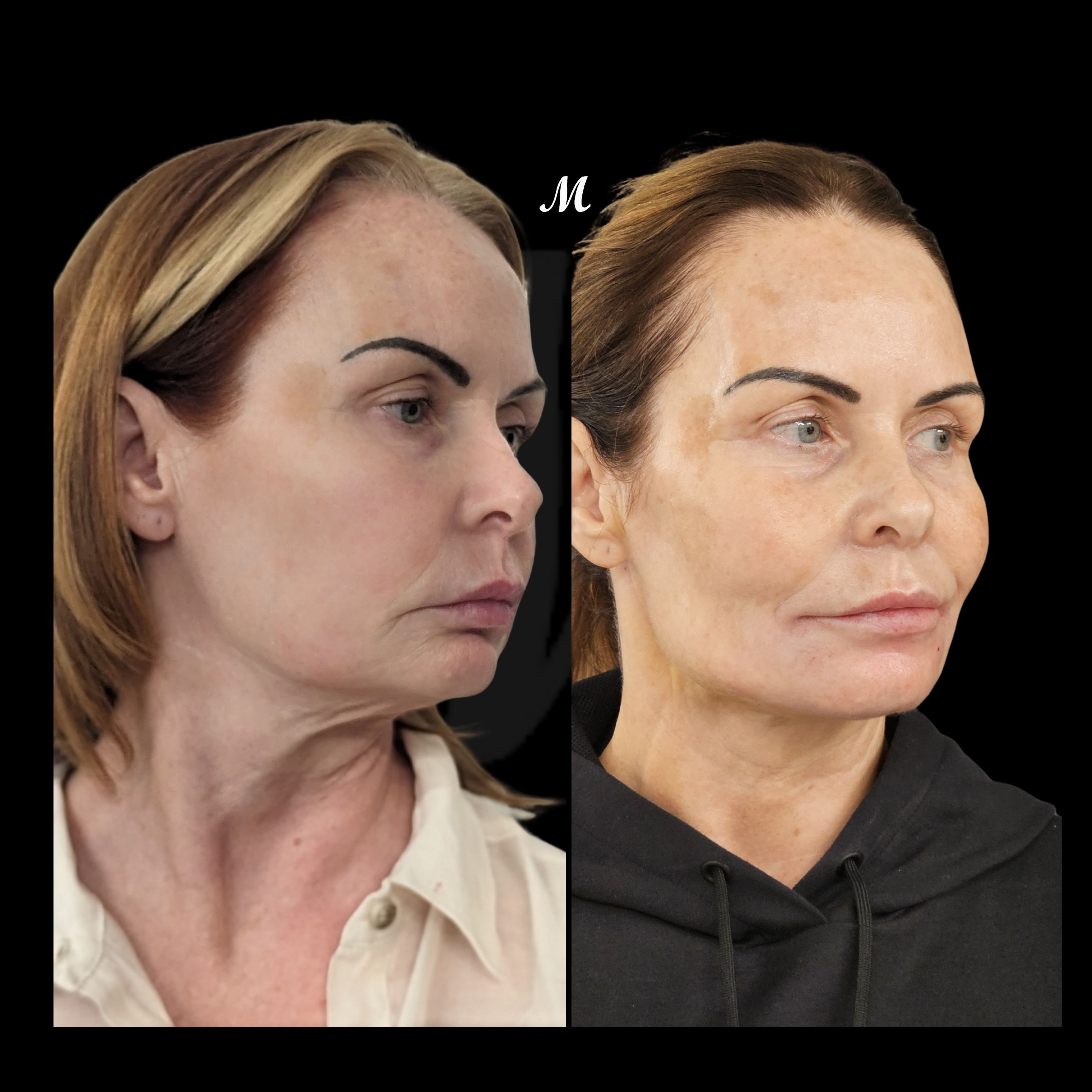 Face & Neck Thread Lift